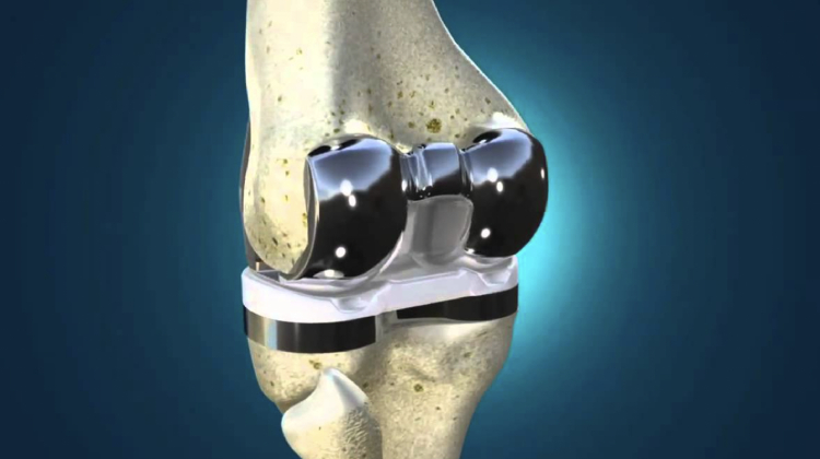 Prótesis de Rodilla en Irapuato